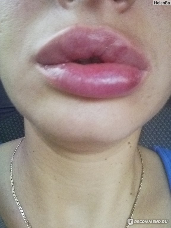 Ահա, թե ինչի կարող է հանգեցնել շուրթերի անհաջող մեծացումը