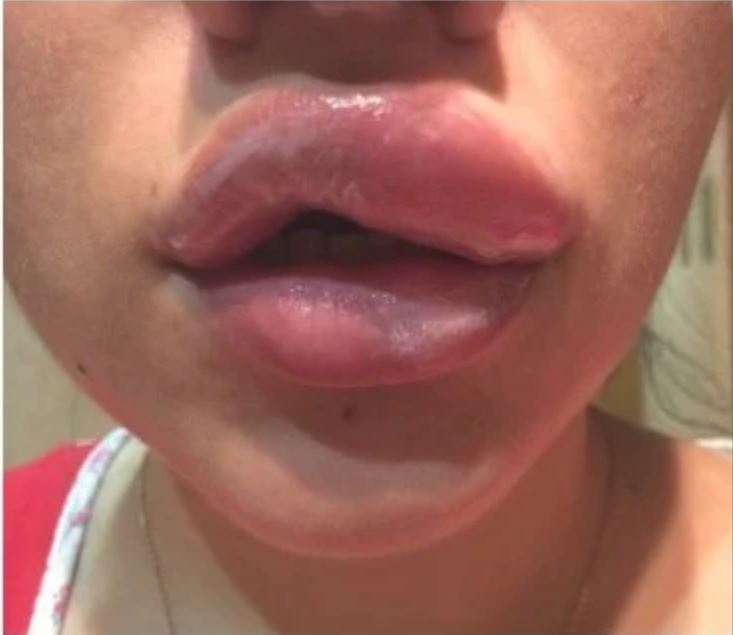 Ահա, թե ինչի կարող է հանգեցնել շուրթերի անհաջող մեծացումը