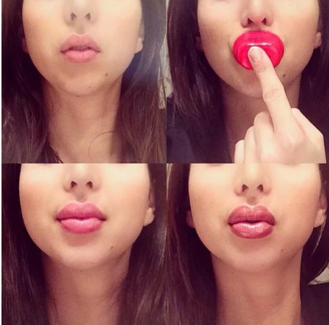 Ահա, թե ինչի կարող է հանգեցնել շուրթերի անհաջող մեծացումը