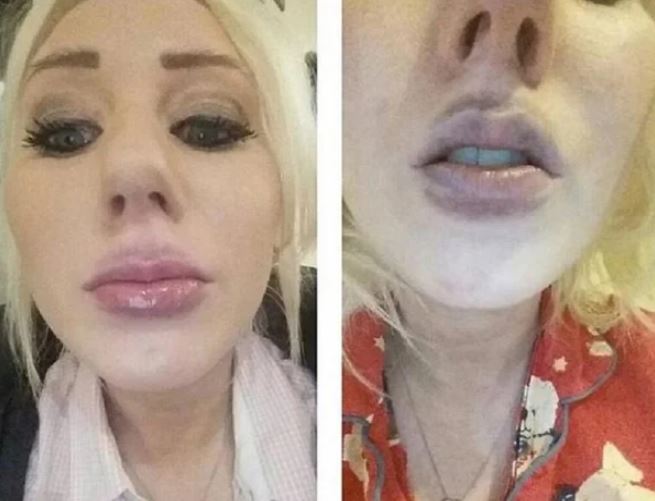 Ահա, թե ինչի կարող է հանգեցնել շուրթերի անհաջող մեծացումը