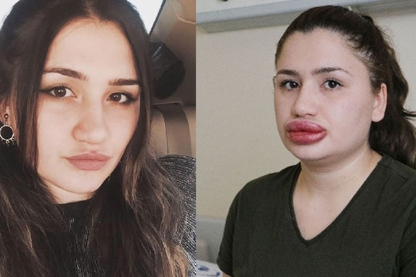 Ահա, թե ինչի կարող է հանգեցնել շուրթերի անհաջող մեծացումը