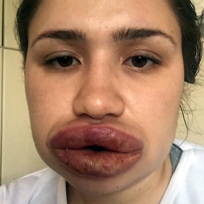 Ահա, թե ինչի կարող է հանգեցնել շուրթերի անհաջող մեծացումը