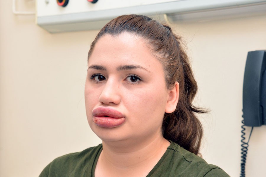 Ահա, թե ինչի կարող է հանգեցնել շուրթերի անհաջող մեծացումը