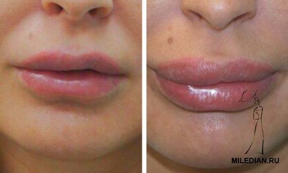 Ահա, թե ինչի կարող է հանգեցնել շուրթերի անհաջող մեծացումը