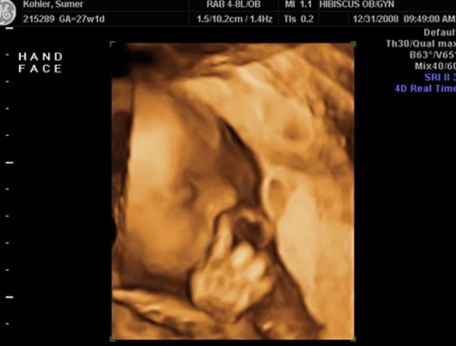 ՈՒլտրաձայնային հետազոտության 15 զվարճալի կադր ապագա մայրիկներից, որոնք Ձեզ անտարբեր չեն թողնի։