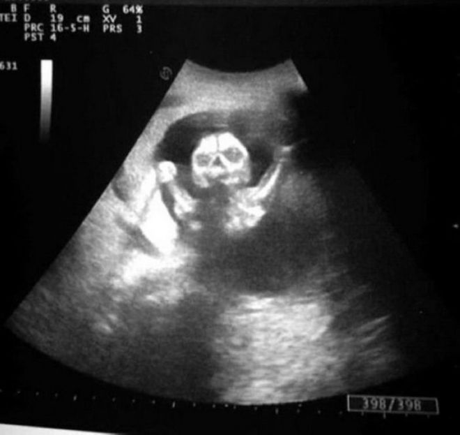 ՈՒլտրաձայնային հետազոտության 15 զվարճալի կադր ապագա մայրիկներից, որոնք Ձեզ անտարբեր չեն թողնի։