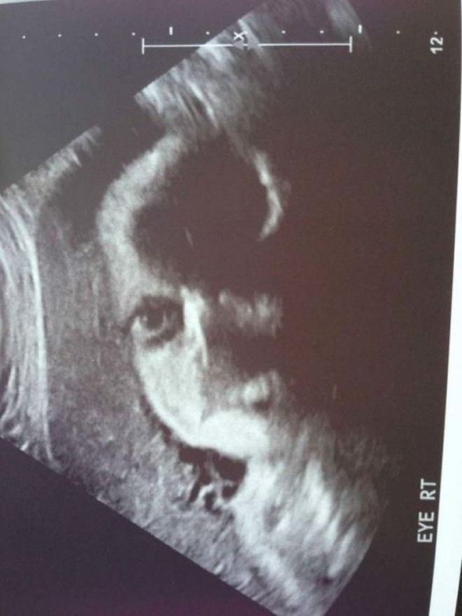 ՈՒլտրաձայնային հետազոտության 15 զվարճալի կադր ապագա մայրիկներից, որոնք Ձեզ անտարբեր չեն թողնի։