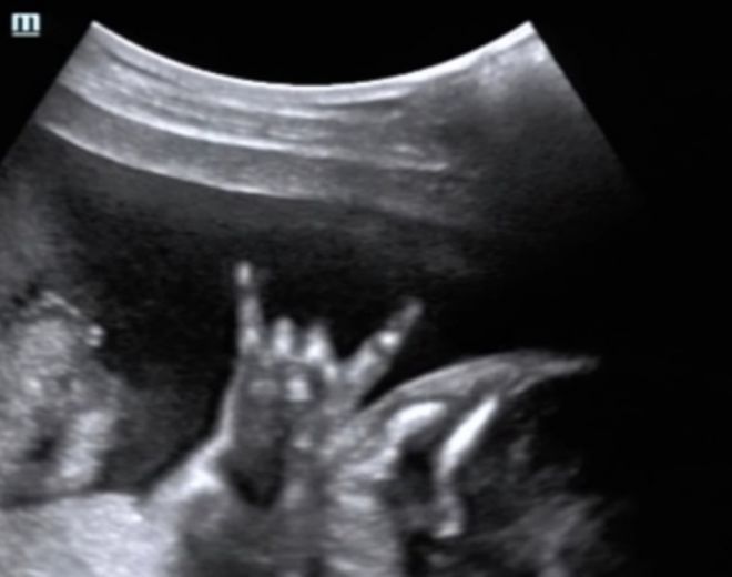 ՈՒլտրաձայնային հետազոտության 15 զվարճալի կադր ապագա մայրիկներից, որոնք Ձեզ անտարբեր չեն թողնի։