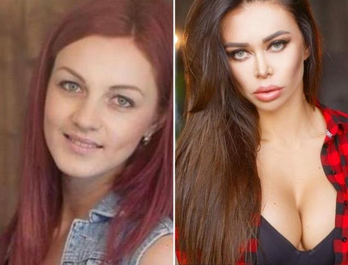 Պլաստիկ վիրաբույժների 18 հիվանդներ, որոնք, անշուշտ, զղջում են իրենց արածի համար, բայց արդեն ուշ է