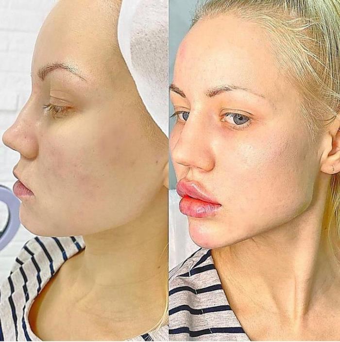 Պլաստիկ վիրաբույժների 18 հիվանդներ, որոնք, անշուշտ, զղջում են իրենց արածի համար, բայց արդեն ուշ է