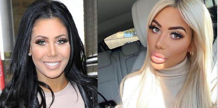 Պլաստիկ վիրաբույժների 18 հիվանդներ, որոնք, անշուշտ, զղջում են իրենց արածի համար, բայց արդեն ուշ է