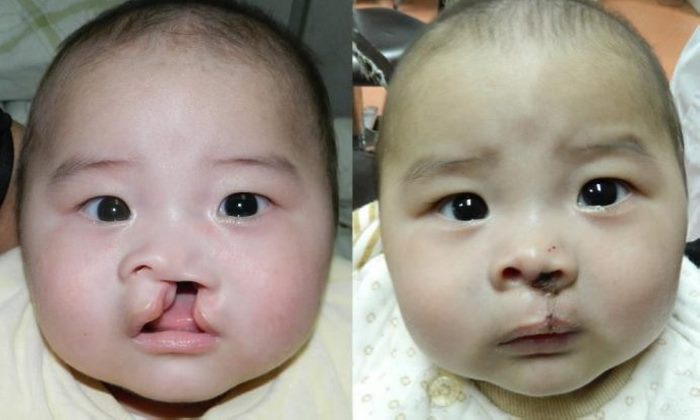 8 լուսանկար, թե ինչու է պլաստիկ վիրաբուժությունը իրականում անհրաժեշտ