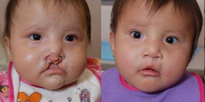 8 լուսանկար, թե ինչու է պլաստիկ վիրաբուժությունը իրականում անհրաժեշտ