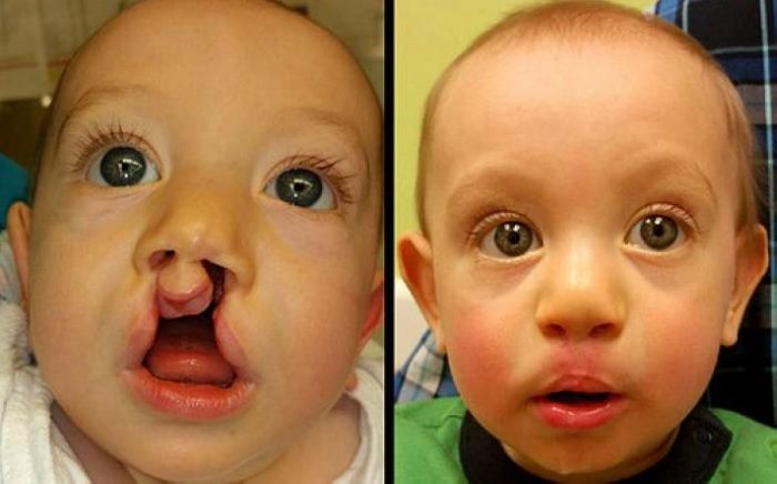 8 լուսանկար, թե ինչու է պլաստիկ վիրաբուժությունը իրականում անհրաժեշտ