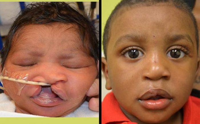 8 լուսանկար, թե ինչու է պլաստիկ վիրաբուժությունը իրականում անհրաժեշտ