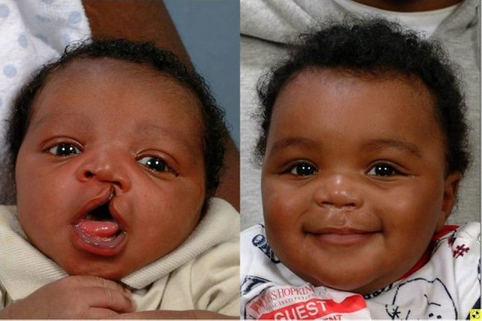 8 լուսանկար, թե ինչու է պլաստիկ վիրաբուժությունը իրականում անհրաժեշտ