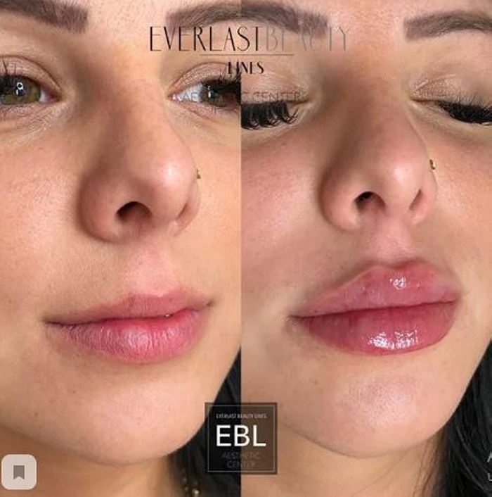 Ինչպիսի տեսք ունեն շուրթերը մեծացումից հետո