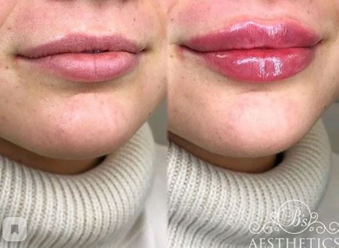 Ինչպիսի տեսք ունեն շուրթերը մեծացումից հետո