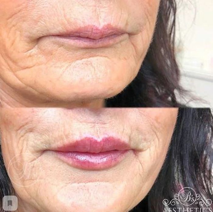 Ինչպիսի տեսք ունեն շուրթերը մեծացումից հետո