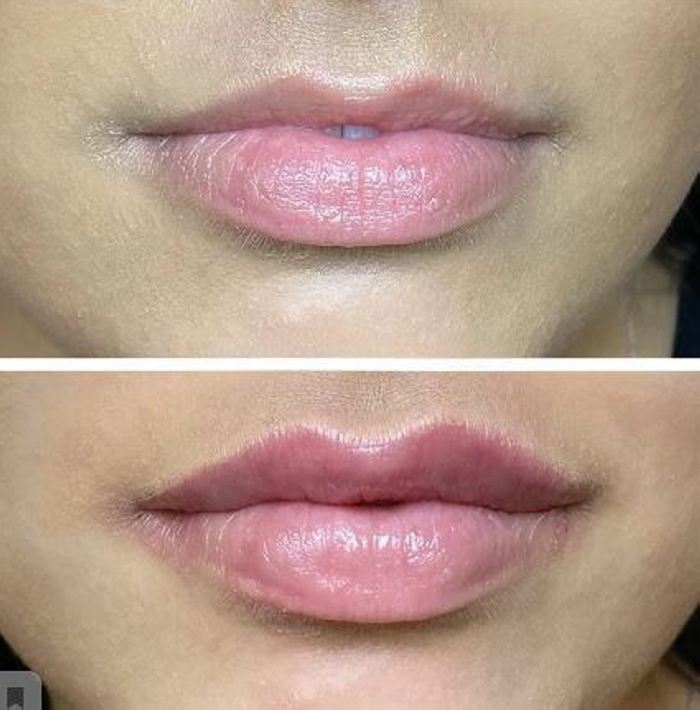 Ինչպիսի տեսք ունեն շուրթերը մեծացումից հետո