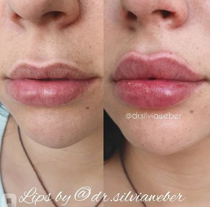 Ինչպիսի տեսք ունեն շուրթերը մեծացումից հետո