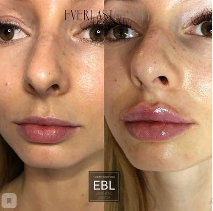 Ինչպիսի տեսք ունեն շուրթերը մեծացումից հետո