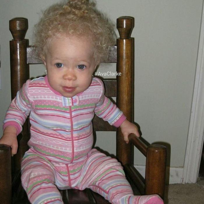 Աֆրիկյան ալբինոս աղջիկը իր առանձնահատկությունը վերածել է արժանապատվության