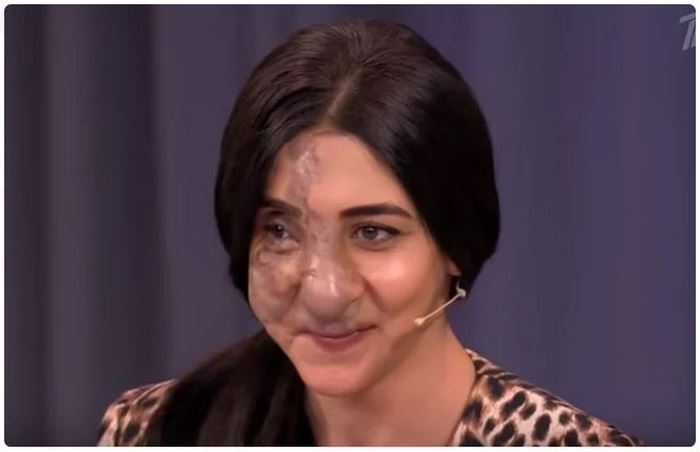 Իր արտաքին տեսքի պատճառով աղջիկը չէր կարողանում դուրս գալ տնից։ Ինչպես է փոխվել թոք-շոուի հերոսուհին երկարատև բուժումից և Գոհար Ավետիսյանի դիմահարդարումից հետո