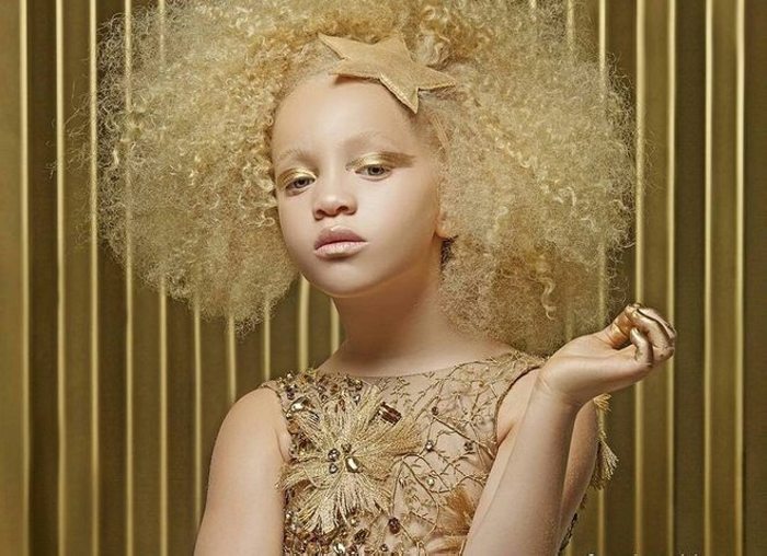 Աֆրիկյան ալբինոս աղջիկը իր առանձնահատկությունը վերածել է արժանապատվության