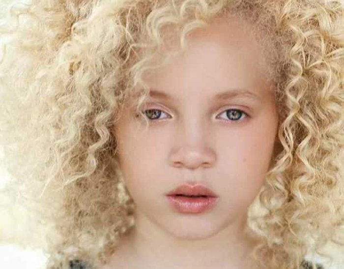 Աֆրիկյան ալբինոս աղջիկը իր առանձնահատկությունը վերածել է արժանապատվության