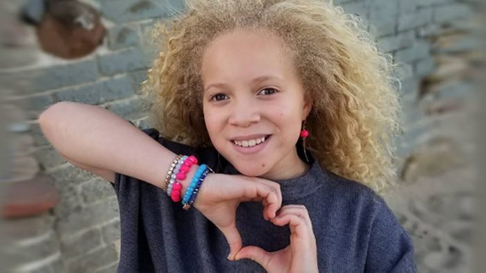 Աֆրիկյան ալբինոս աղջիկը իր առանձնահատկությունը վերածել է արժանապատվության