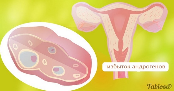 Ձվարանների պոլիկիստոզ. ախտանիշեր, որոնք պետք է մտահոգեն