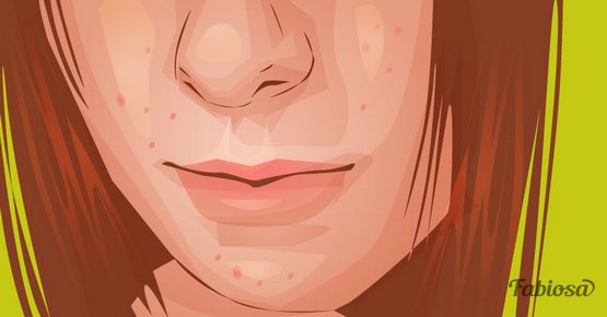 Ձվարանների պոլիկիստոզ. ախտանիշեր, որոնք պետք է մտահոգեն