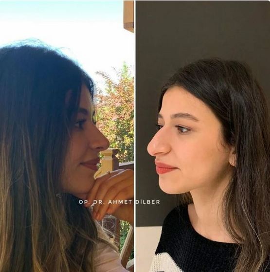 &laquo;Քիթը ամեն ինչի գլուխն է&raquo;: Ռինոպլաստիկայից հետո կերպարանափոխված աղջիկների լուսանկարները