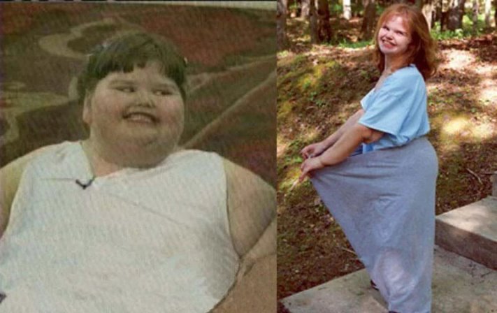 Ինչպի՞սի տեսք ունի աշխարհի ամենագեր աղջիկն այժմ` նիհարելուց հետո