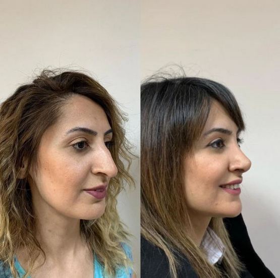 &laquo;Քիթը ամեն ինչի գլուխն է&raquo;: Ռինոպլաստիկայից հետո կերպարանափոխված աղջիկների լուսանկարները
