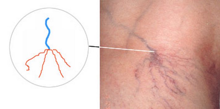 Ինչպես ազատվել անոթային աստղիկներից