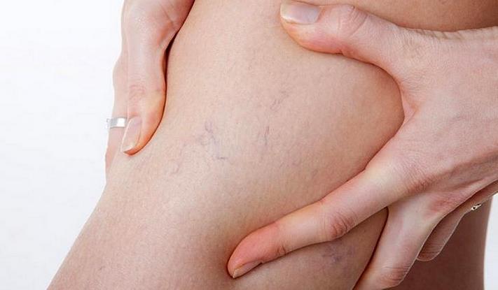 Ինչպես ազատվել անոթային աստղիկներից