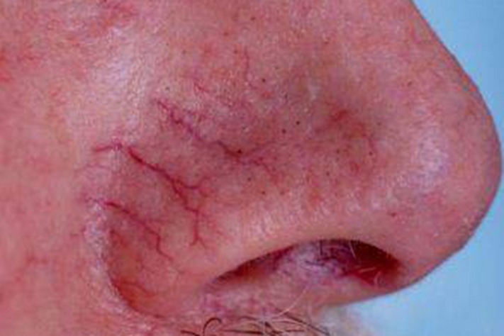 Ինչպես ազատվել անոթային աստղիկներից