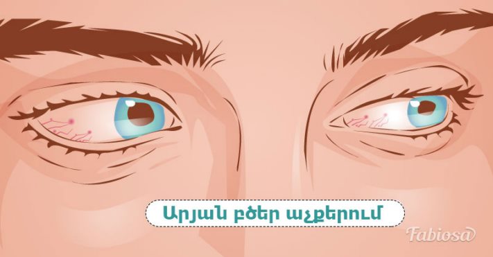 Երեք մարդուց մեկն արյան բարձր ճնշում ունի, բայց նա նույնիսկ չի կասկածում այդ մասին. համոզվեք, որ սա ձեր մասին չէ