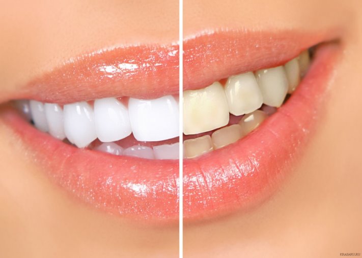 Բնական հիանալի միջոց՝ ատամների որակյալ սպիտակեցման համար