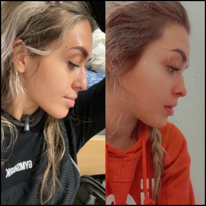 15 մարդ, ովքեր որոշեցին պլաստիկ վիրահատության ենթարկվել և այժմ միայն ափսոսում են, որ դա ավելի վաղ չեն արել