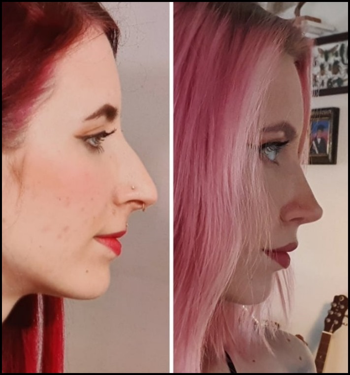 15 մարդ, ովքեր որոշեցին պլաստիկ վիրահատության ենթարկվել և այժմ միայն ափսոսում են, որ դա ավելի վաղ չեն արել