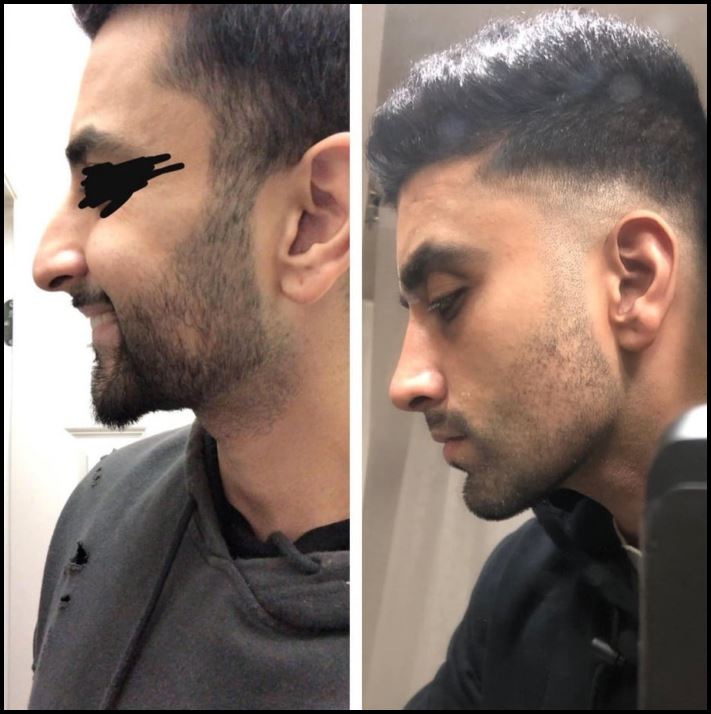 15 մարդ, ովքեր որոշեցին պլաստիկ վիրահատության ենթարկվել և այժմ միայն ափսոսում են, որ դա ավելի վաղ չեն արել