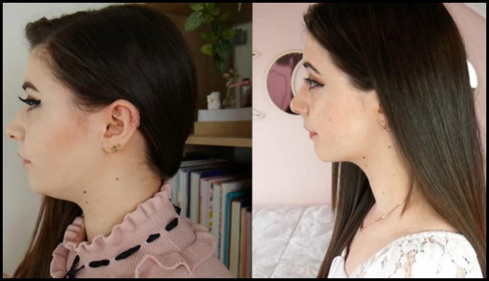 15 մարդ, ովքեր որոշեցին պլաստիկ վիրահատության ենթարկվել և այժմ միայն ափսոսում են, որ դա ավելի վաղ չեն արել