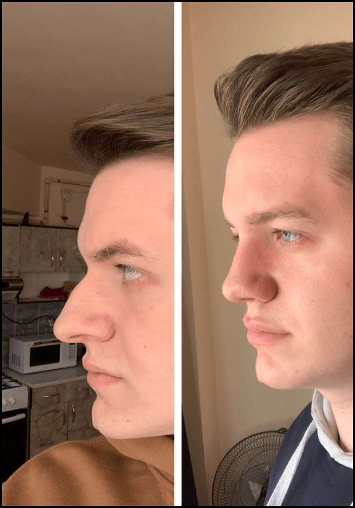 15 մարդ, ովքեր որոշեցին պլաստիկ վիրահատության ենթարկվել և այժմ միայն ափսոսում են, որ դա ավելի վաղ չեն արել