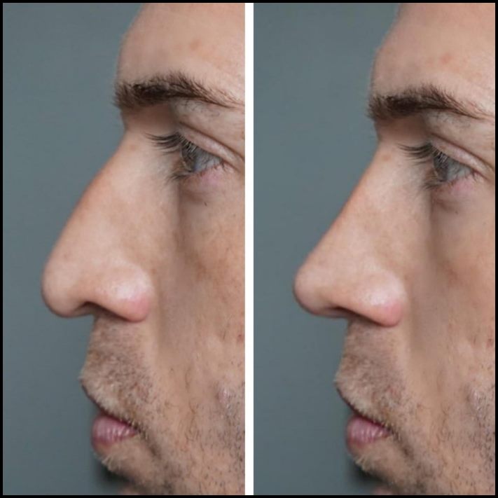 15 մարդ, ովքեր որոշեցին պլաստիկ վիրահատության ենթարկվել և այժմ միայն ափսոսում են, որ դա ավելի վաղ չեն արել