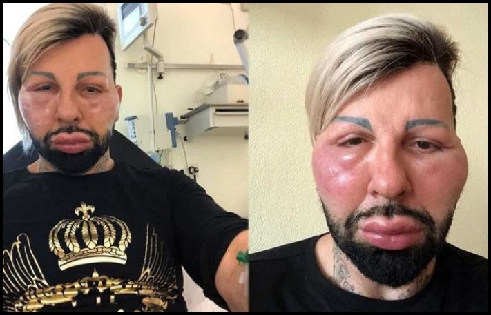 14 մարդ պլաստիկ վիրահատությունից հետո, որոնց ավելի լավ է չնայել