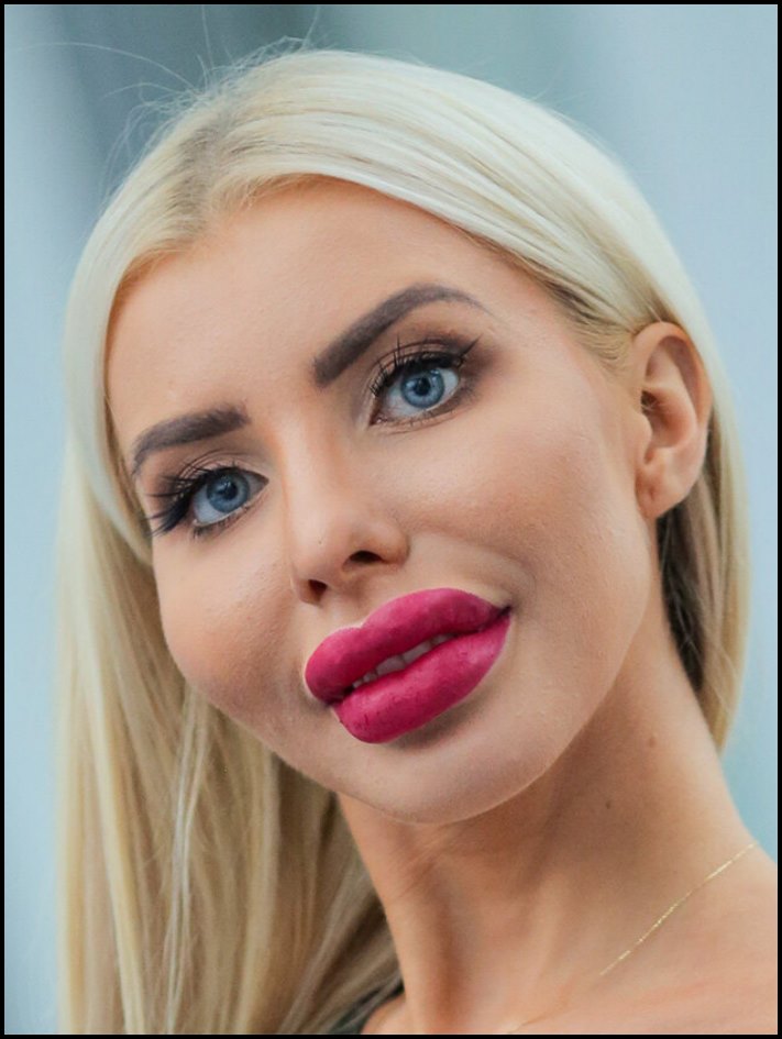 Դեմքի կեսը փչել են: 10 աղջիկ, ովքեր չափը շատ անցան՝ շրթունքների մեծացման հարցում