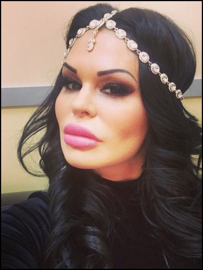 Դեմքի կեսը փչել են: 10 աղջիկ, ովքեր չափը շատ անցան՝ շրթունքների մեծացման հարցում